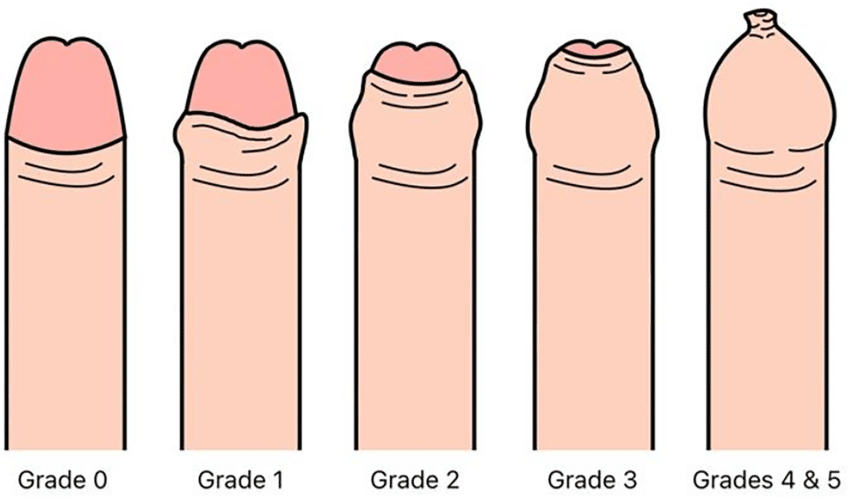 Phimosis 2 The Kikiros classification of phimosis severity 5 Grade 0 fully retractile prepuce